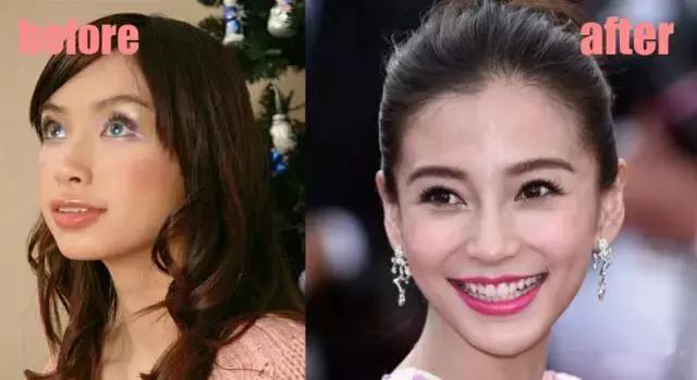 整牙刘涛,整牙改变脸型杨幂