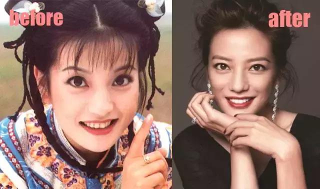 整牙刘涛,整牙改变脸型杨幂