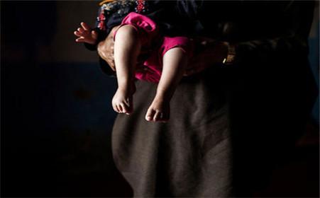 小儿麻痹怎么预防,小儿麻痹症需要特殊教育吗