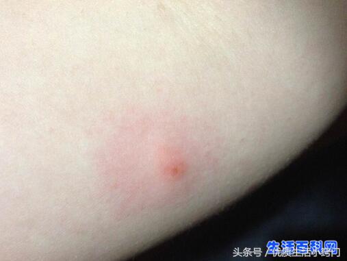 跳蚤咬的过敏症状图片,跳蚤咬的症状图片和危害