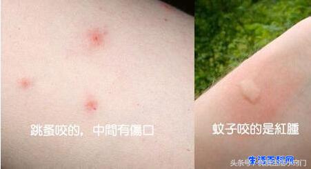跳蚤咬的过敏症状图片,跳蚤咬的症状图片和危害