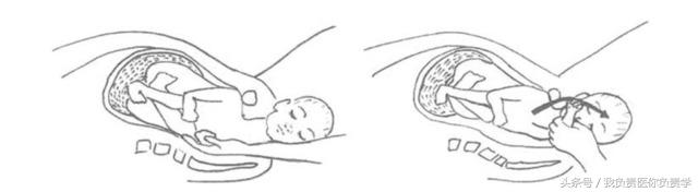 肩难产演练视频全部过程,产妇出现肩难产视频