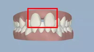 牙缝大矫正多少钱,小孩牙缝大怎么矫正