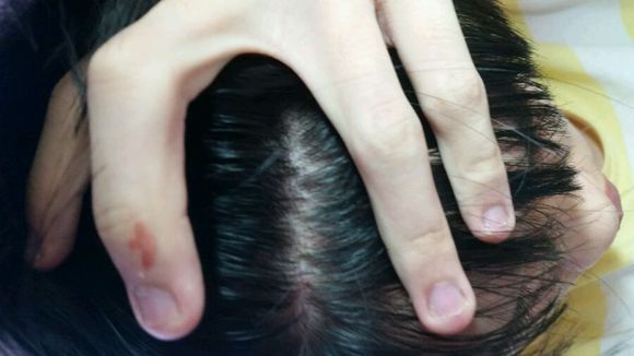 头部脂溢性皮炎，头油，头痒，头屑多，中医用1种针具扣刺