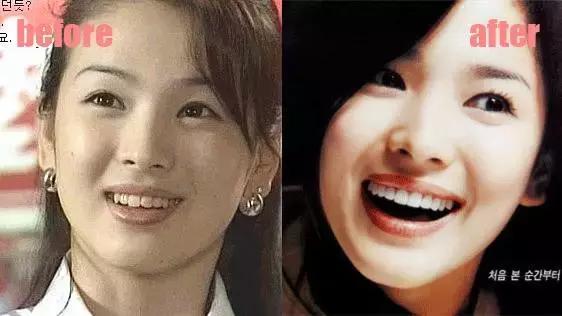 整牙刘涛,整牙改变脸型杨幂
