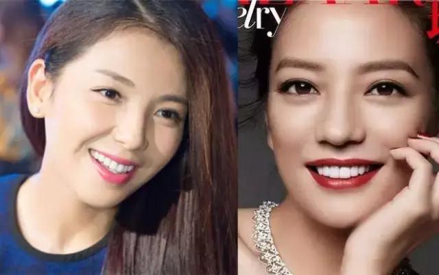 整牙刘涛,整牙改变脸型杨幂