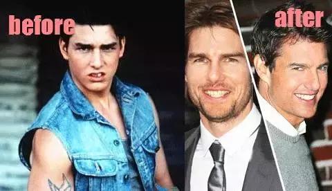 整牙刘涛,整牙改变脸型杨幂