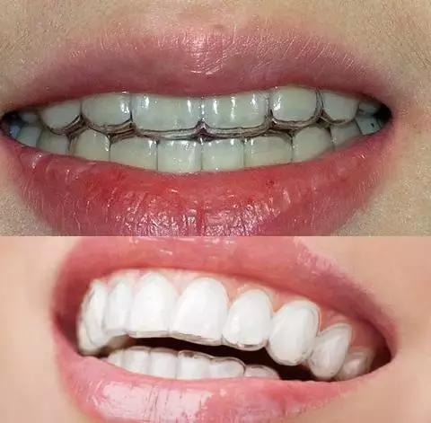 整牙刘涛,整牙改变脸型杨幂