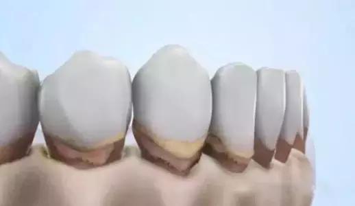 牙结石萎缩的牙龈还会恢复么,牙龈萎缩牙缝变大可以恢复吗