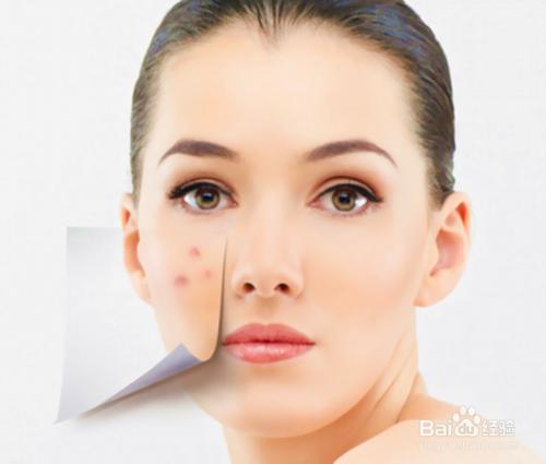 如何有效根治痘痘和预防痘痘,用什么方法去除痘痘最有效