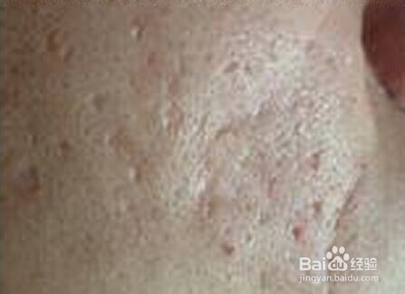 如何有效根治痘痘和预防痘痘,用什么方法去除痘痘最有效