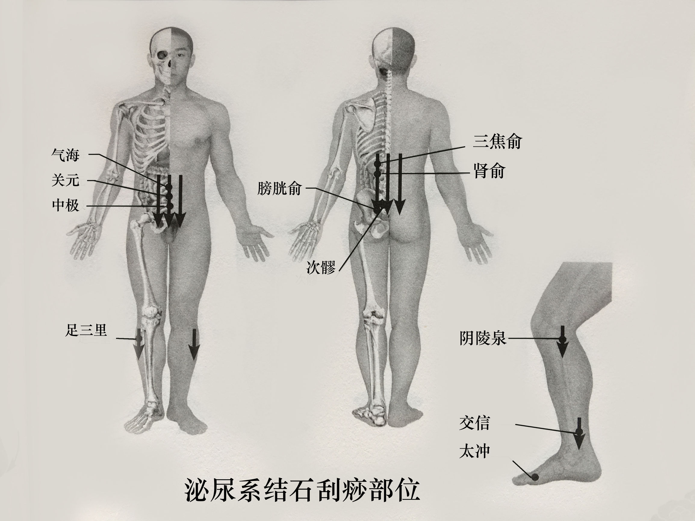 泌尿道结石止痛用药,尿结石穴位按摩止痛法