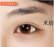 做了双眼皮后眼皮按压痛,为什么割了双眼皮牙会痛