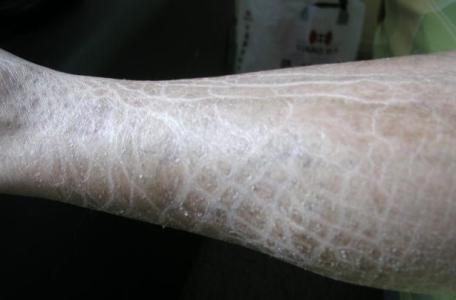 他身上长满了“鱼鳞”，因此找不到对象，到底怎么回事呢？