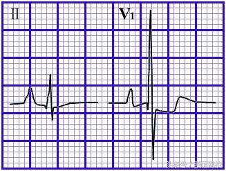 郭雅卿心电图讲解全集,郭雅卿心血管视频课
