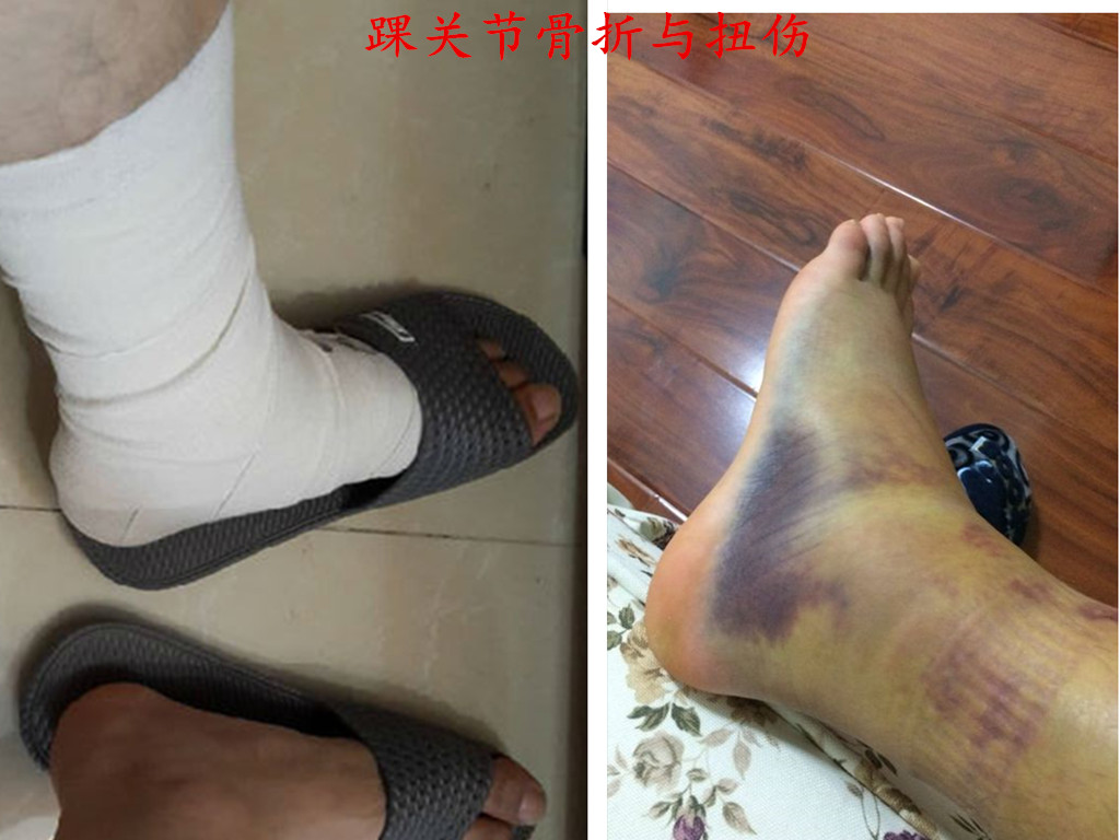 踝关节放血针刺什么部位,踝关节扭伤刺血疗法