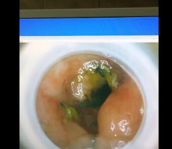 低位直肠癌保肛冷冻治疗多少费用,低位直肠癌患者保肛后存活率