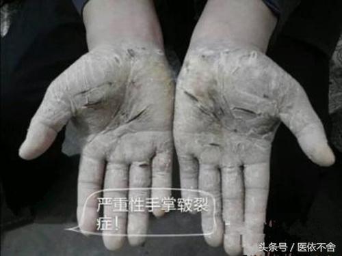 天气冷手脚干裂怎么办,秋冬季节手脚干裂用啥药