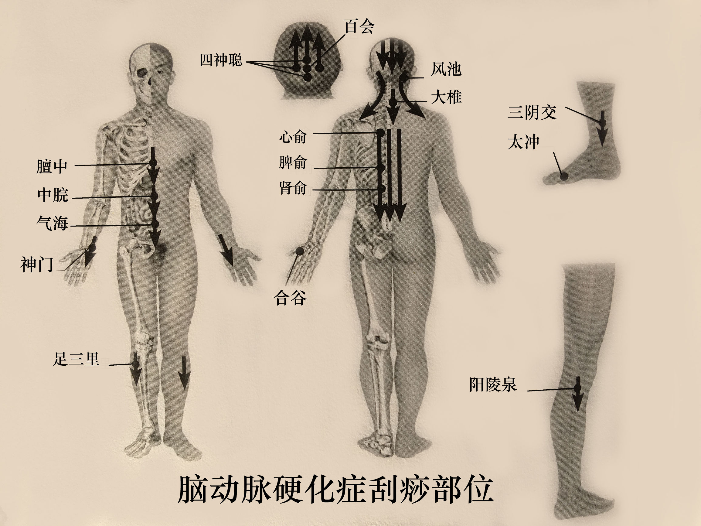 脑血栓患者可以做头部刮痧吗,脑动脉硬化的中医治疗
