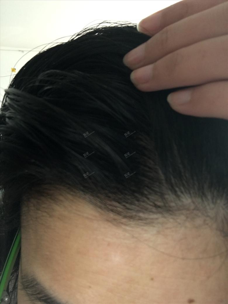 治疗头皮痒头皮屑偏方,治疗头皮发红大片头皮屑的方法