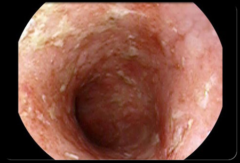 癌症最怕的三味中药,中药治愈18种癌症的药方