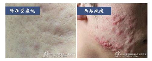 微针治痘坑涂碘伏,微针对深痘坑有效吗