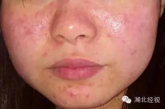 全身发痒是新冠吗怎么治疗,得新冠全身痒