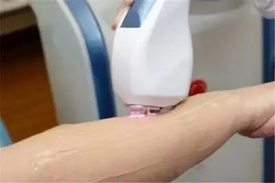 激光脱毛需要多久才能掉胡须,激光脱毛是把毛刮干净再用激光吗