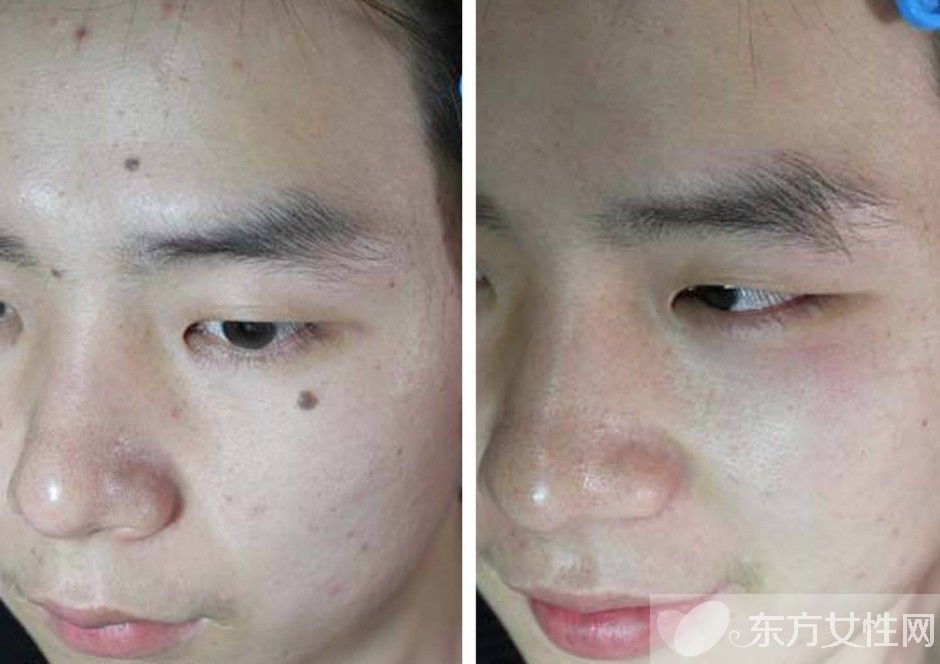 点痣后关注事项有哪些,点痣后关注事项与饮食禁忌食谱