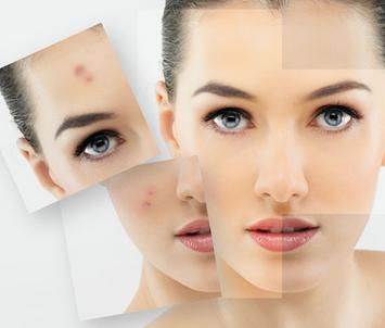 鼻子上反复长脓包型痘痘的原因,鼻子上长痘痘怎么快速消除学生党