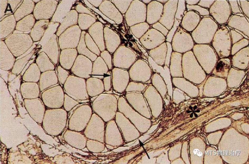 筋膜的润滑液——透明质酸