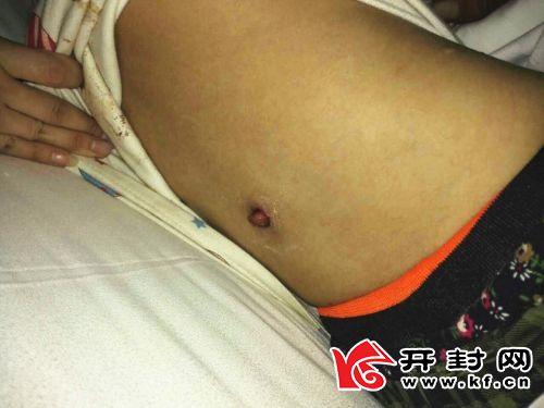 震惊！开封小女孩体内插入异物多日