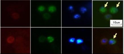 肿瘤细胞的清除,肿瘤细胞清除靠的是什么免疫