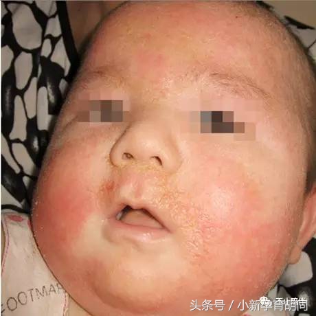 宝宝头上有湿疹,宝宝脸上的湿疹