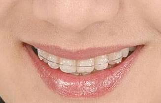 牙齿难看怎么矫正,牙齿丑不拉几怎么在家解决