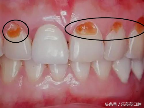 牙齿烂了只剩根部怎么拔掉,牙齿根部烂了怎么回事