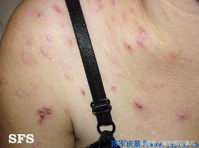 神经性皮炎激素药膏使用的两个“禁忌”