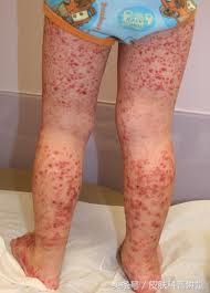 双小腿起红疹子是什么原因,双小腿出现有一片红点是什么原因