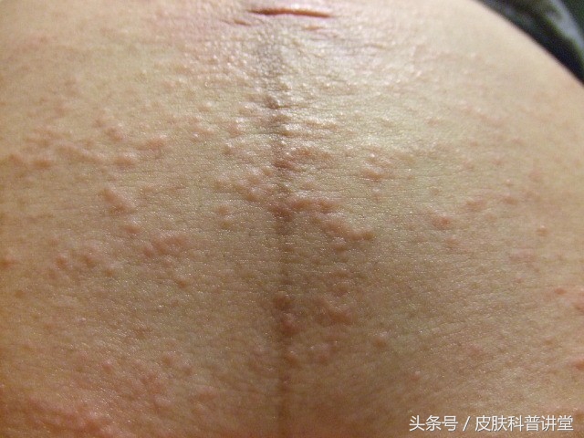 妊娠期瘙痒症出现皮疹怎么办,妊娠期皮肤瘙痒