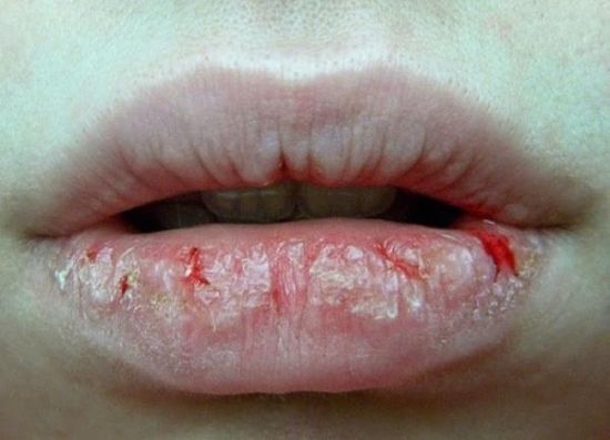 嘴唇又干又起皮,嘴唇又干脱皮还发脓该怎么办