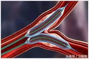 微创介入科一卫毅楠,什么是心血管介入治疗