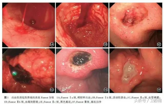 微创介入科一卫毅楠,什么是心血管介入治疗