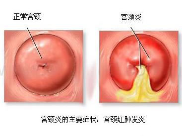 支原体妇科炎症有哪些表现,妇科宫颈炎症有哪些症状表现