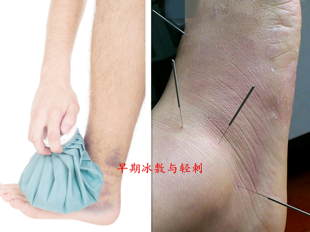 踝关节放血针刺什么部位,踝关节扭伤刺血疗法