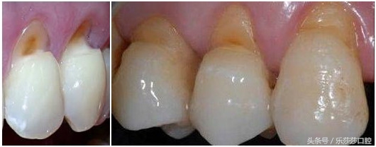 牙齿烂了只剩根部怎么拔掉,牙齿根部烂了怎么回事