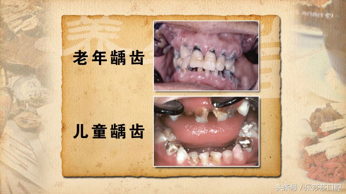 牙齿烂了只剩根部怎么拔掉,牙齿根部烂了怎么回事