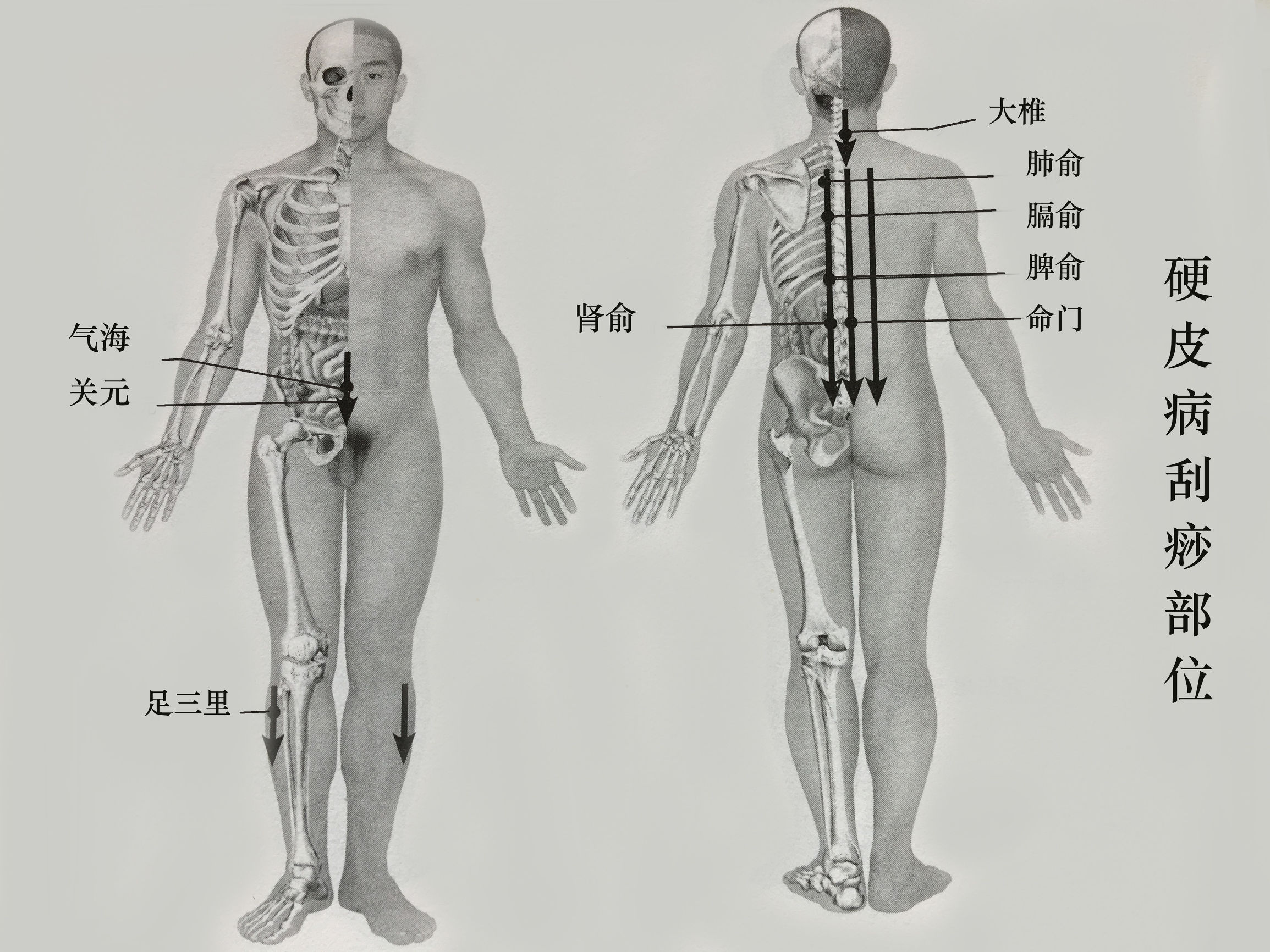 硬皮病针灸疗法能治愈吗,硬皮病针灸处方