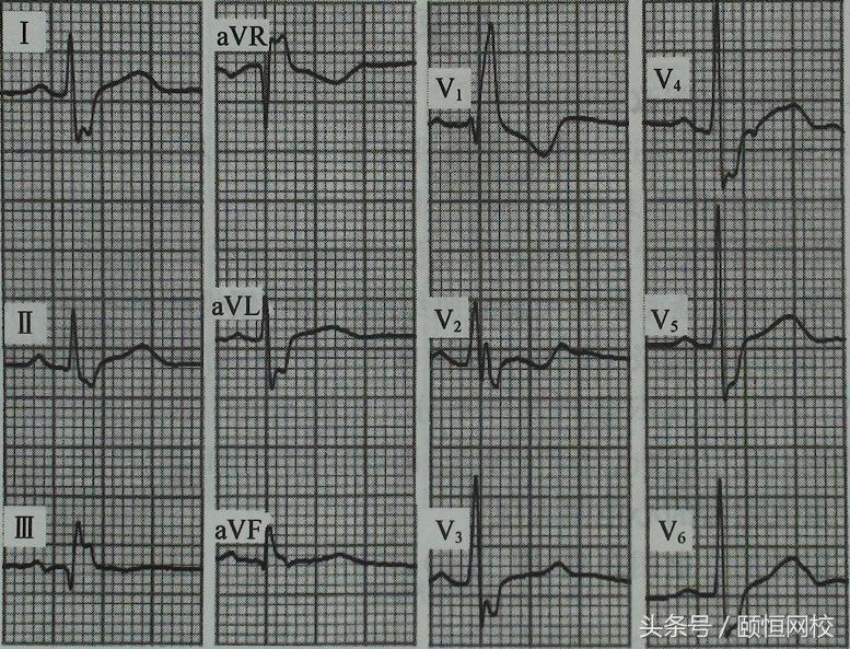 郭雅卿心电图讲解全集,郭雅卿心血管视频课
