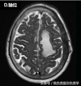 头顶长了包子似的疙瘩是什么,头顶长了个包是肿瘤吗