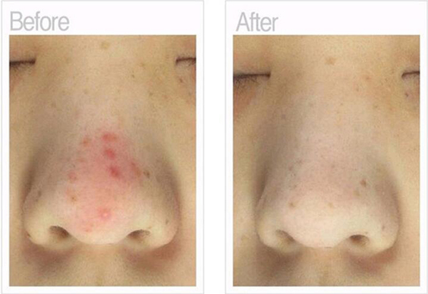 小孩鼻子周围长痘痘是什么原因,鼻子嘴唇周围长痘痘是什么原因